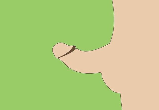 độ cong của dương vật là một dấu hiệu cho việc mở rộng phẫu thuật